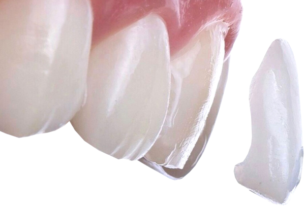 Керамические виниры Emax